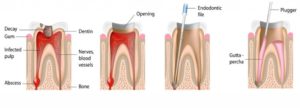 endodonzia lomturismodentale